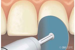 Материалы для полировки зубов и пломб